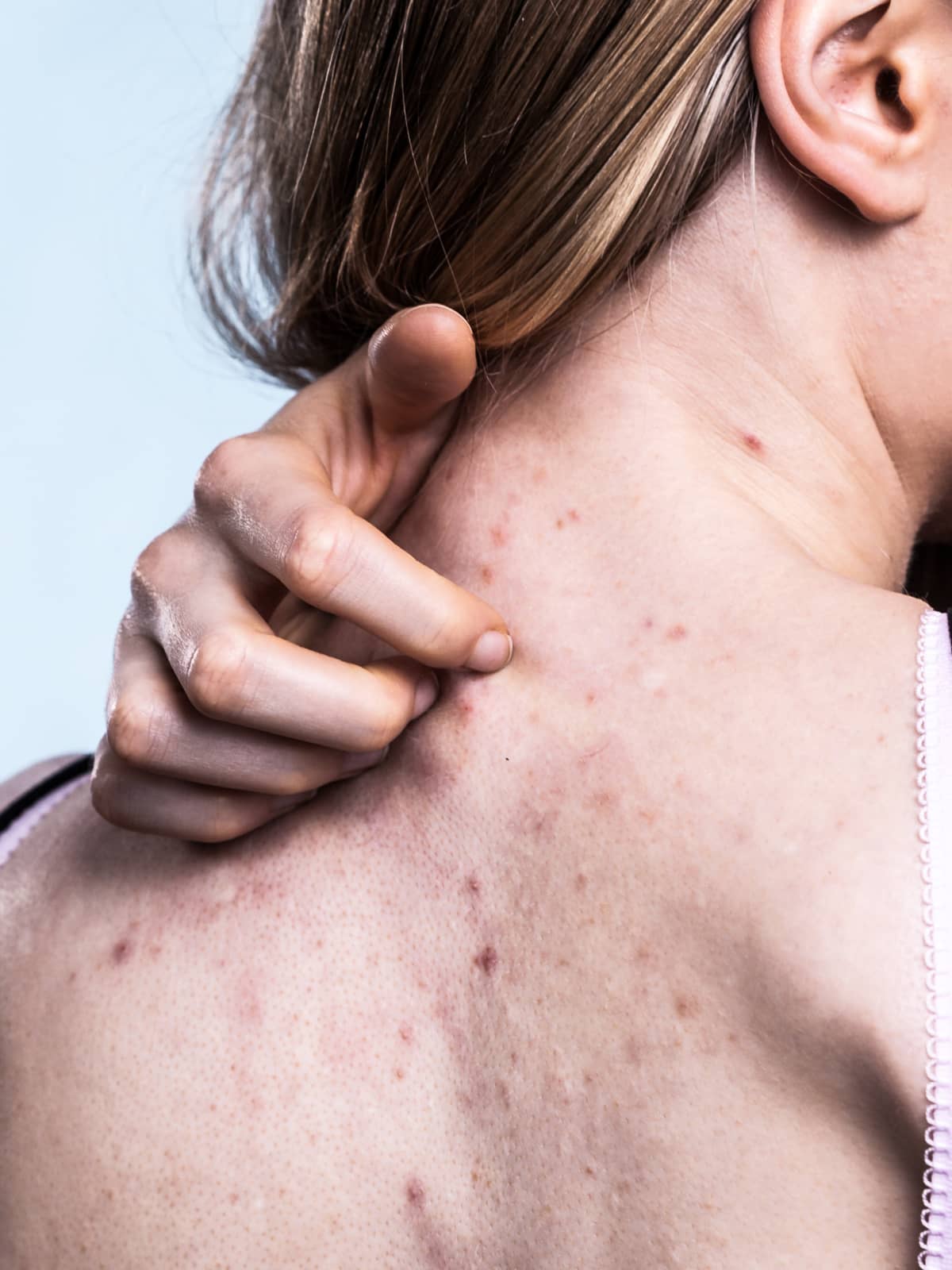 Woman scratching the back of her neck where she has back acne