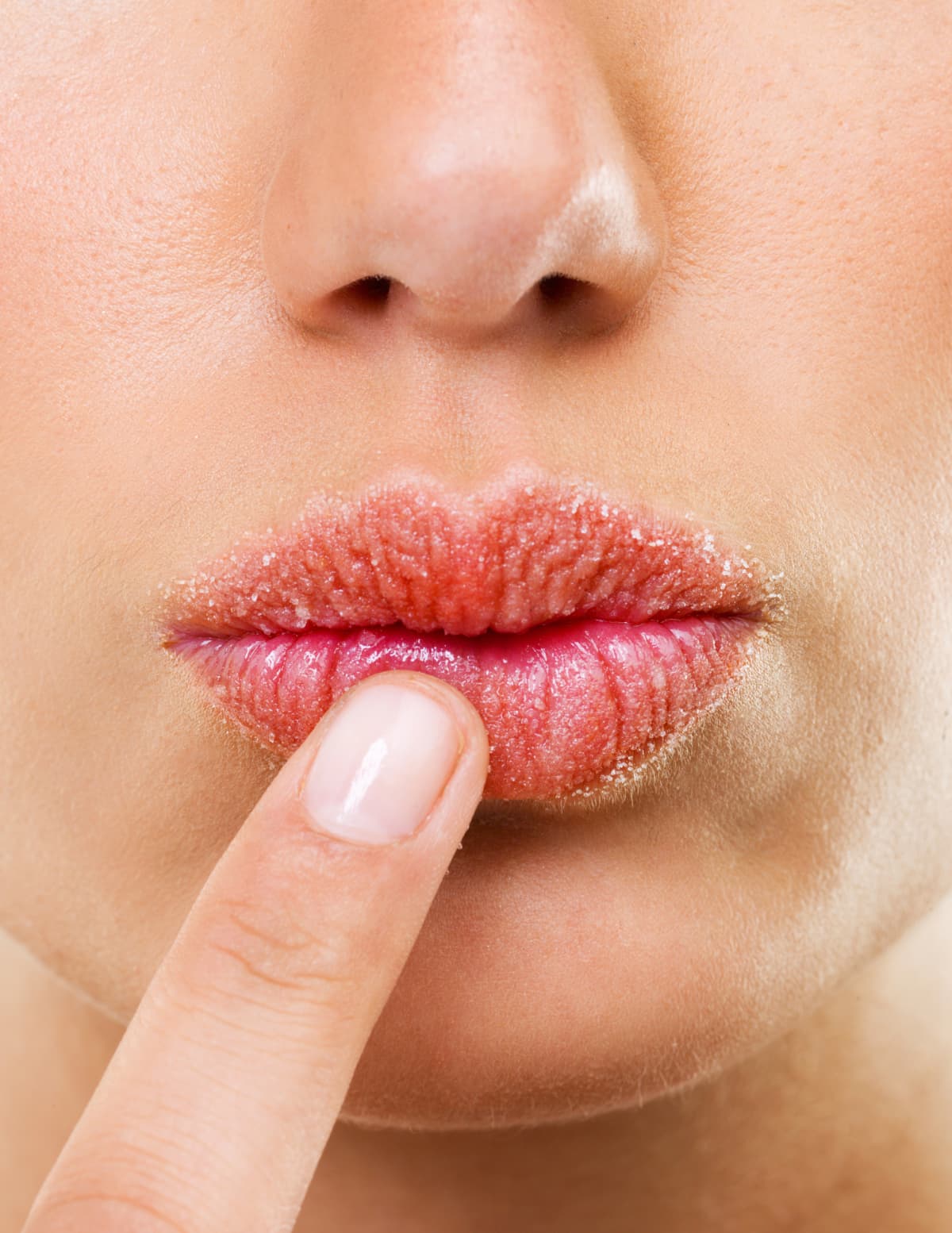 Lips affected by herpes. Treatment with a cotton swab.