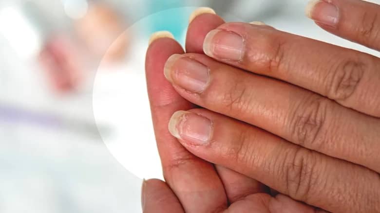 Diabetes type 2 symptoms: High blood sugar signs include nail lines |  Express.co.uk