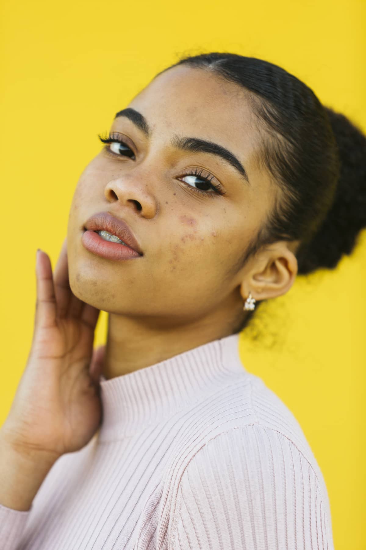 Portrait of a woman with acne posing in front of a yellow background